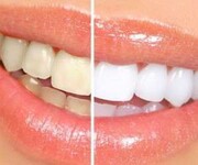 ۴ روش برای داشتن دندان‌هایی سفید