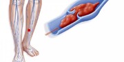 علت لخته شدن خون در پا را جدی بگیرید / بیماری DVT چیست؟