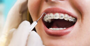 بهترین سرویس ارتودنسی دندان را در کلینیک دندانپزشکی دکتر سریتا تجربه کنید