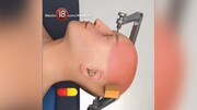 ویدیو جالب و دیده‌نشده از نحوه جراحی مغز که تا به حال ندیده‌اید!