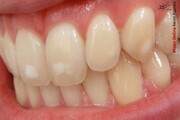 عوارض و فواید جرم گیری دندان چیست؟
