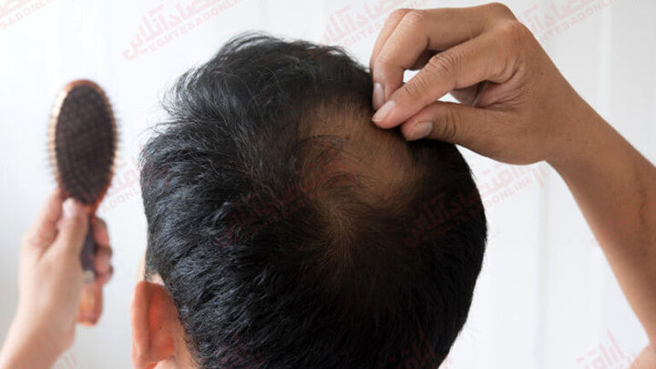  جلوگیری از ریزش موی آقایان با ۱۷ روش 