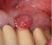 علت آبسه دندان بعد از ایمپلنت دندان چیست؟ + روش درمان
