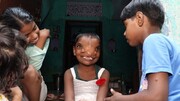 دختر شش ساله هندی که دو تا بینی دارد! / عکس