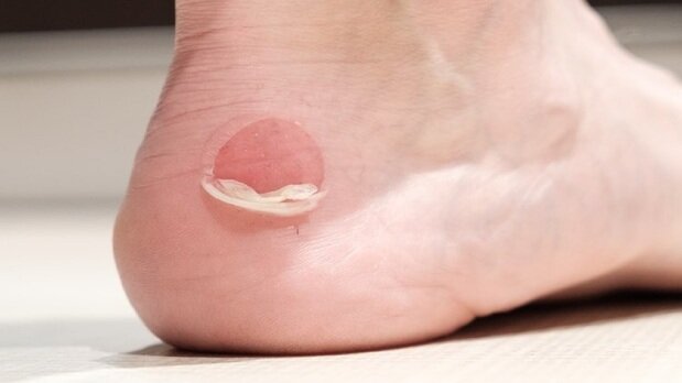 درمان تاول پا با چند روش ساده و خانگی!
