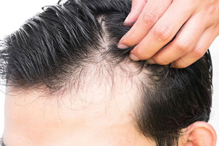 روش درمان ریزش مو پس از بیماری کرونا