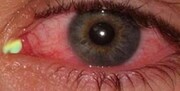 مراقب عوارض چشمی ویروس کرونا باشید / احتمال نابینایی وجود دارد!