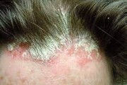 دلیل حساسیت پوست سر و پوسته پوسته شدن آن چیست؟