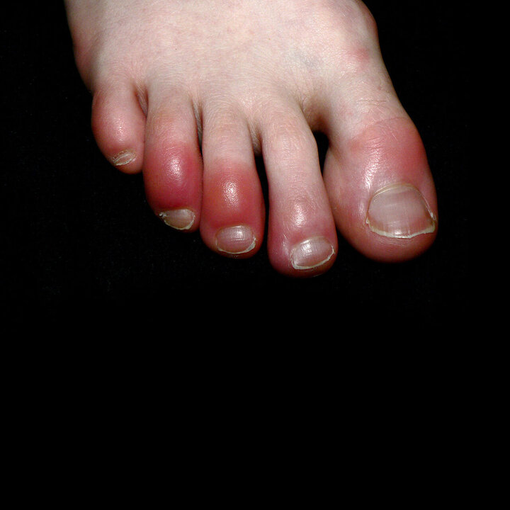 انگشت پای کوویدی چیست؟