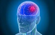 مرگ‌ومیر بیماران مغز و اعصاب افزایش یافت؛ علت چیست؟