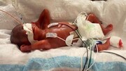 نارس‌ترین نوزاد جهان که ۵ ماه زود به دنیا آمد | تولد نوزاد زودرس ۴ماهه با نیم کیلو وزن