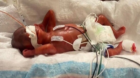 زودرس‌ترین نوزاد جهان که ۱۹ هفته زود به دنیا آمد
