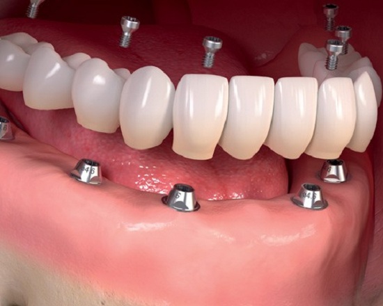 اطلاعاتی در خصوص کاشت دندان 