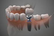 اطلاعاتی در خصوص کاشت دندان