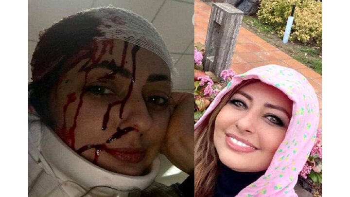 ماجرای کتک خوردن بازیگر زن از همسرش چیست؟! + عکس و سند درخواست از پزشکی قانونی