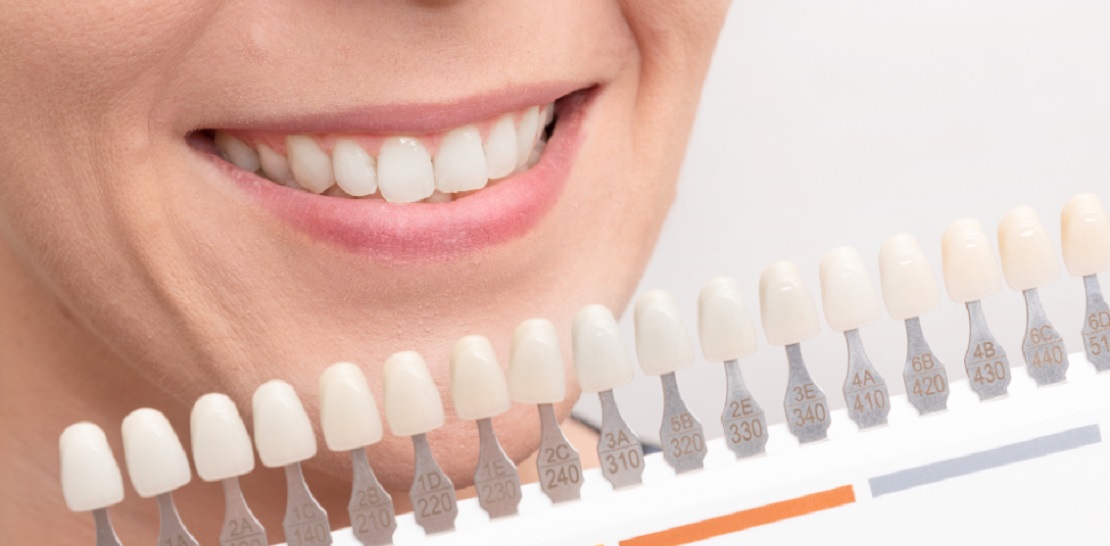 گران ترین و ارزان ترین راه های سفید کردن دندان