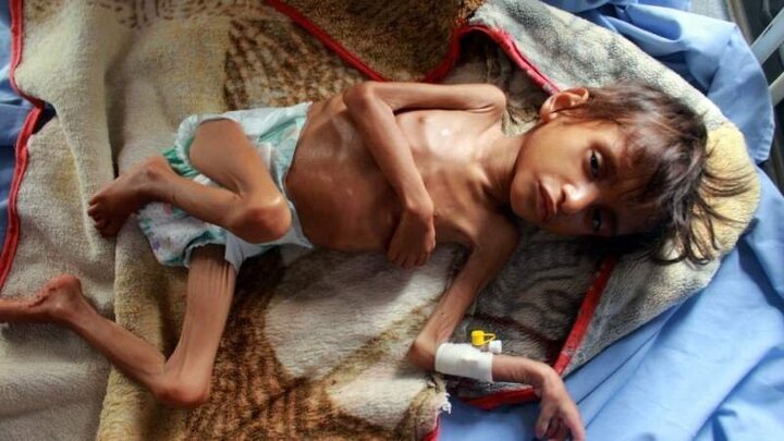 برنامه جهانی غذا نسبت به سطح بی‌سابقه گرسنگی در یمن هشدار داد