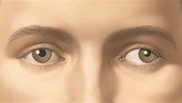 علت انحراف چشم چیست؟ + نحوه درمان / فیلم
