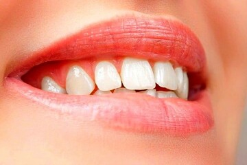 مردم این کشورها بهترین و زیباترین دندان ها را دارند! + آمار
