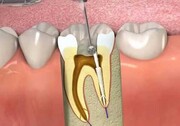 چقدر درباره عصب‌کشی کردن دندان می‌دانید!