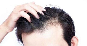 روش های درمان ۵ معضل رایج مو در زمستان