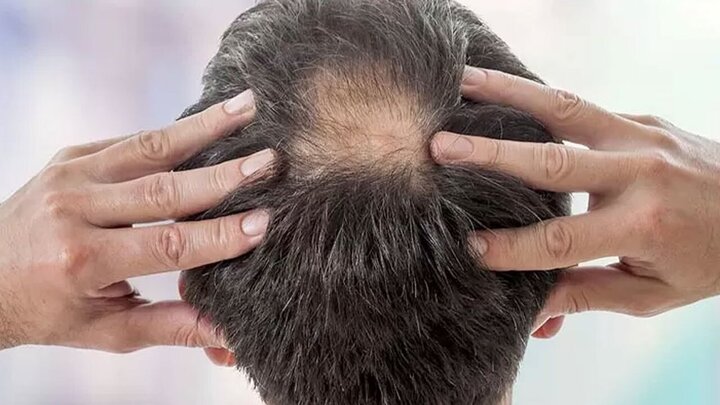 دلیل ریزش مو چیست؟ + نحوه درمان با چند روش ساده / فیلم