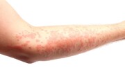 ۶ علامت خطرناک پوستی اومیکرون