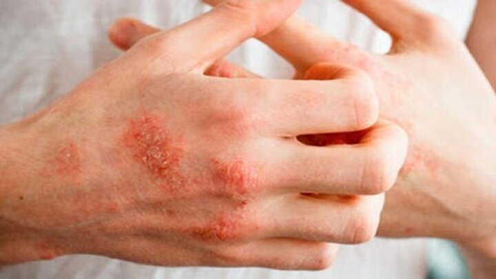 علائم پوستی مبتلایان به ویروس اومیکرون / فیلم