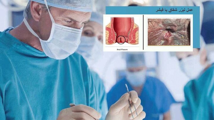 بیماری دردناک شقاق مقعدی را چگونه درمان کنیم؟ بیماری دردناک شقاق مقعدی را چگونه درمان کنیم؟