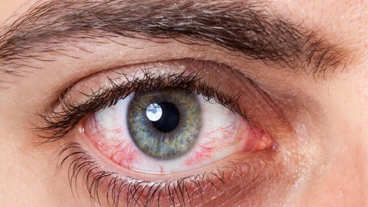 عفونت‌های چشمی را جدی بگیرید / ۶ عفونت چشمی بسیار خطرناک
