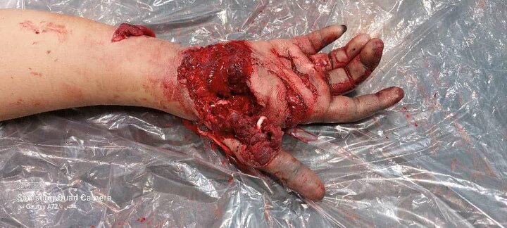 پیوند موفقیت آمیز انگشتان قطع شده جوان ۱۷ ساله در یزد