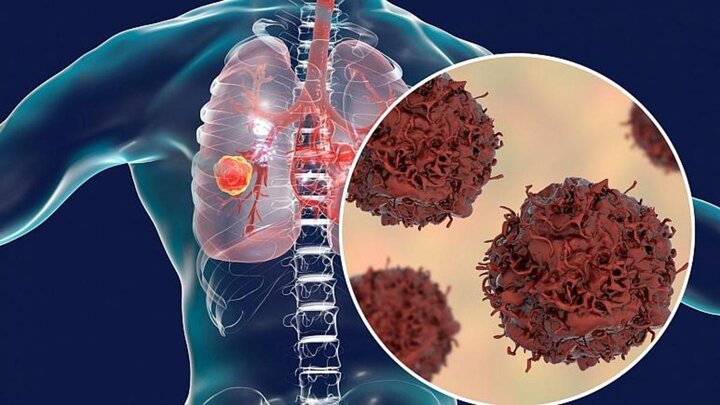 تشخیص سریع سرطان ریه با کمک یک کرم که از باکتری‌ها تغذیه می‌کند