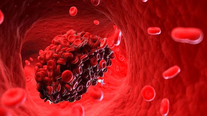 خبر بد محققان درباره لختگی خون در مبتلایان کرونا