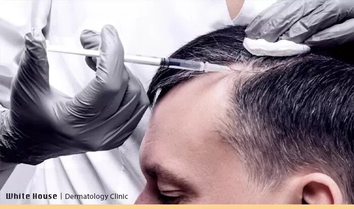 درمان ریزش مو با تزریق هیرفیلر