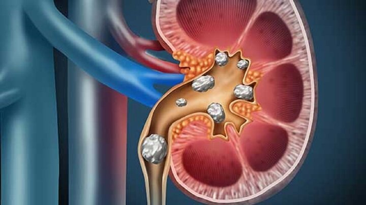 دلیل سنگ ساز شدن کلیه‌ها چیست؟ / فیلم