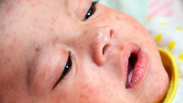 شناسایی ۹۸ بیمار مبتلا به سرخک در ایران / ضرورت واکسیناسیون کودکان علیه سرخک در ۱۲ و ۱۸ ماهگی