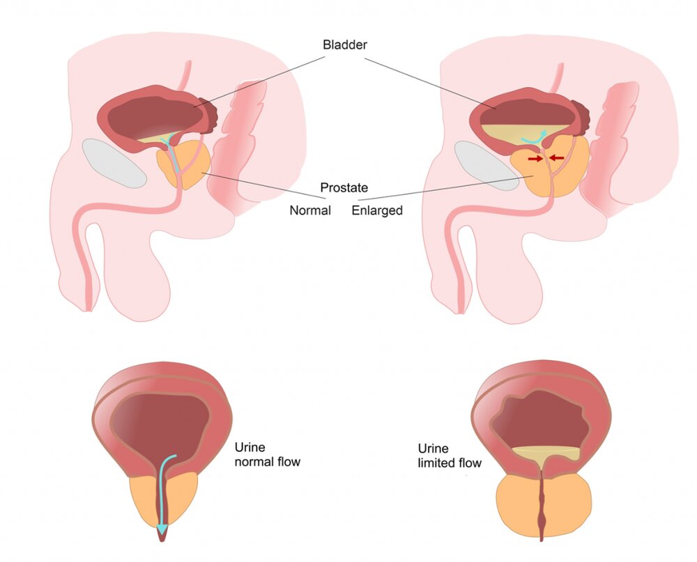 ۷ علامت هشداردهنده سرطان پروستات در مردان