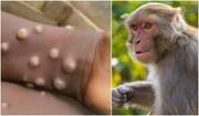 تاثیر واکسن آبله در پیشگیری از ابتلا به "آبله میمونی" چقدر است؟
