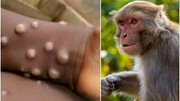 همه چیز درباره بیماری آبله میمونی + جزییات / عکس