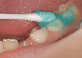 توضیحاتی درباره تاثیر فلوراید بر دندان پوسیده