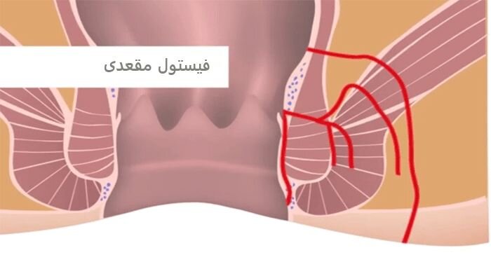 چگونه بهترین جراح برای درمان فیستول را انتخاب کنیم؟ چگونه بهترین جراح برای درمان فیستول را انتخاب کنیم؟