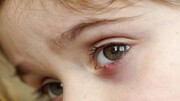 علت اصلی التهاب و خارش چشم چیست؟ +  علائم و نحوه پیشگیری و درمان / فیلم