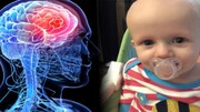 تومور مغزی کودکان با یک ویروس درمان می‌شود