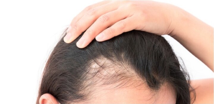  ۵ روش کاربردی برای جلوگیری از ریزش موی سر