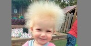 ابتلا کودک به نادرترین بیماری جهان | موهای این کودک عجیب ۱۷ ماهه‌ به هیچ عنوان شانه نمی شود! / فیلم و عکس