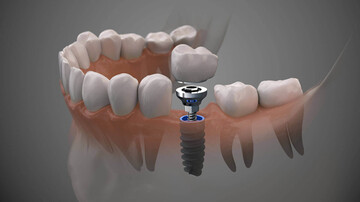 دوام ایمپلنت دندان به چه عواملی بستگی دارد؟