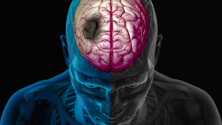 علت اصلی بروز سکته مغزی چیست؟ + عکس