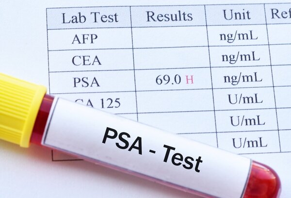 همه چیز در رابطه با آزمایش PSA