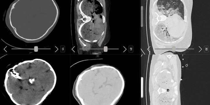 سی‌تی اسکن مهسا امینی منتشر شد + عکس