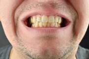 عادات اشتباهی که موجب زردی دندان‌ها می‌شود